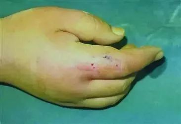 魟鱼刺伤后的症状有哪些表现：魟鱼刺伤后的症状 魟鱼 第1张