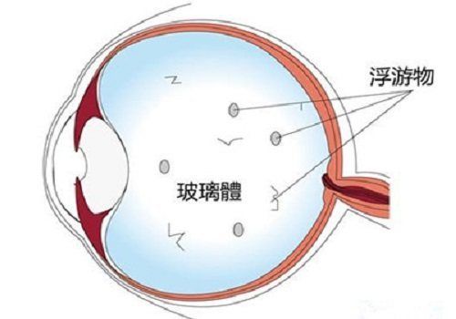 玻璃体浑浊用什么药（玻璃体浑浊怎么办） 福虎/异型虎鱼/纯色虎鱼 第1张